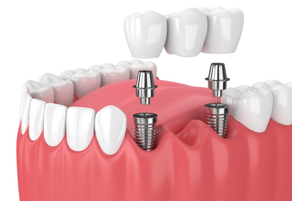 implant-based-bridge-scaled