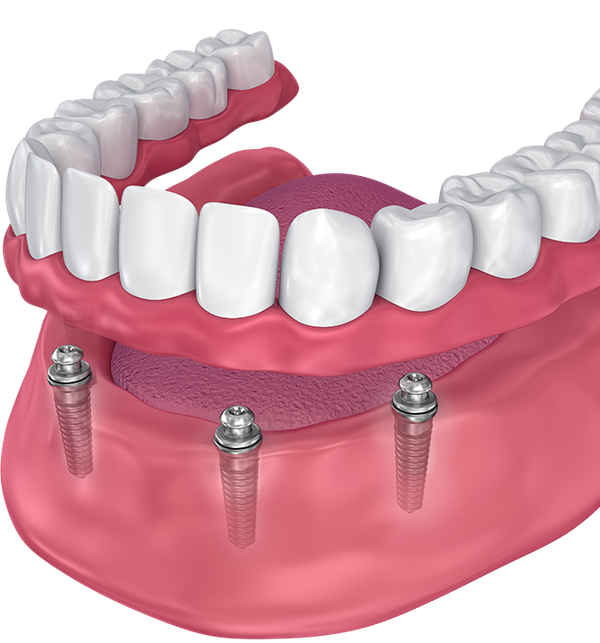 implant-supported-dentures